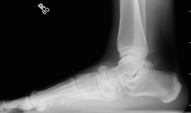 Navicular Fracture Lateral